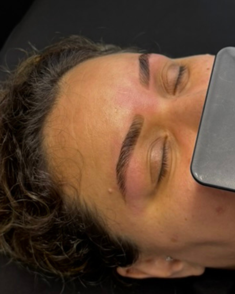 résultat browlift complet mantes la jolie